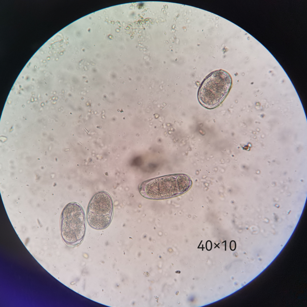 揭秘:一颗不典型钩虫卵引发的"血案"