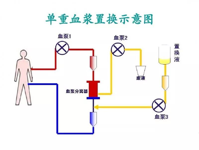 血液净化示意图图片