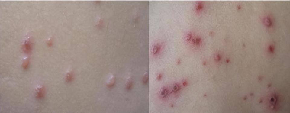 春季水痘高发,如何给孩子预防护理?