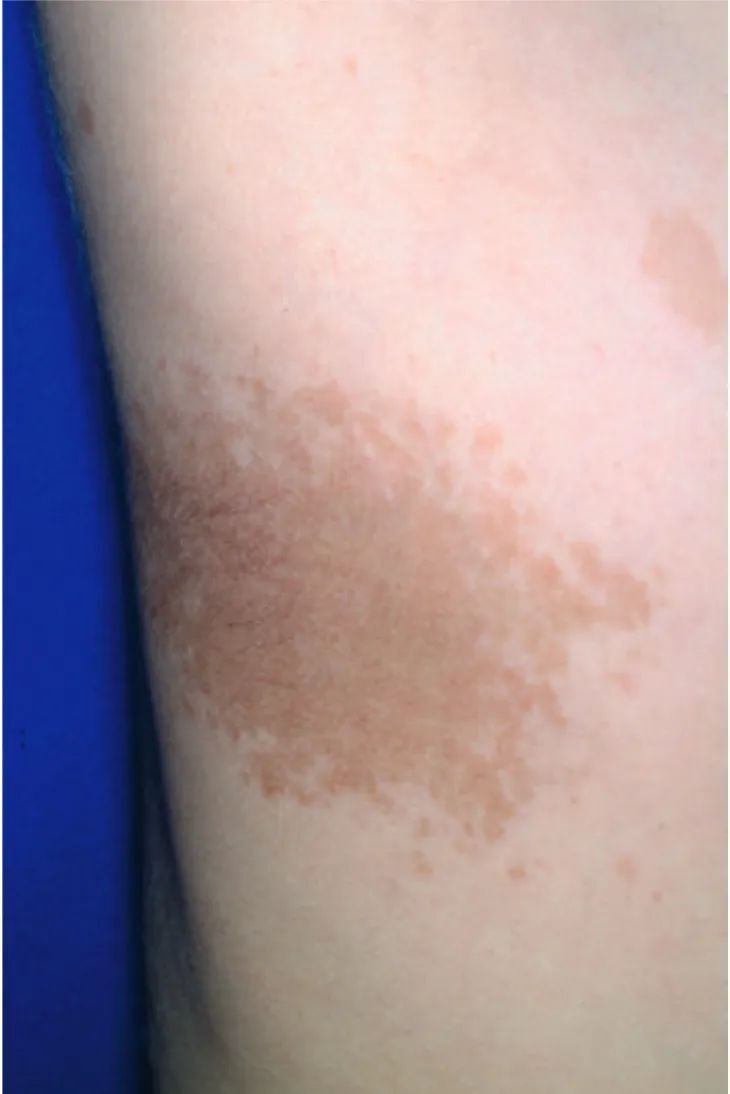 孩子长了多处灰色斑块要警惕「神经纤维瘤病」?专科医生教你怎么看