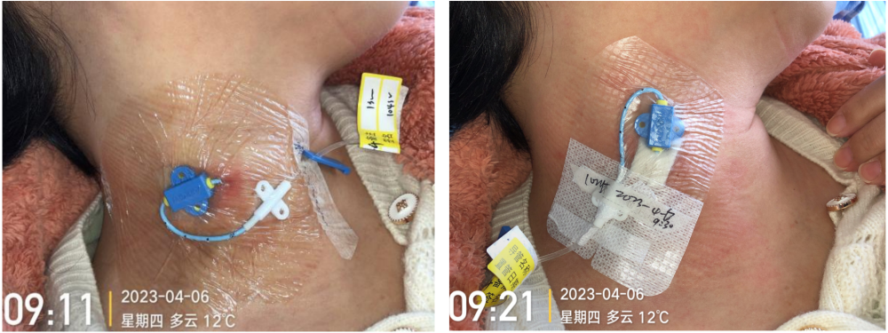 CVC 留置时间是 14 d 还是 30 d？你要的答案来了_腾讯新闻