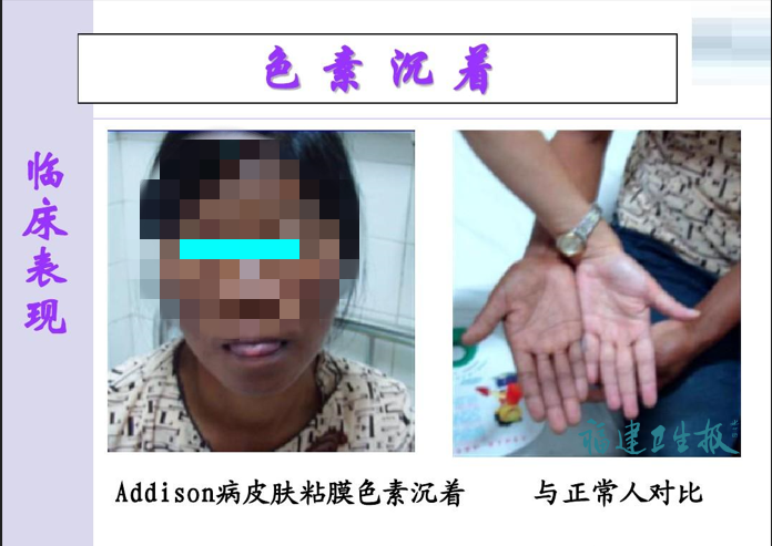 80岁黄阿婆身体莫名变黑、头晕嗜睡，元凶竟是这个？