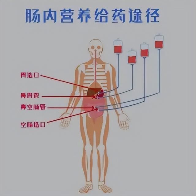 顾名思义,肠内营养就是将营养输送至肠道,而肠外营养将其输送到血液.
