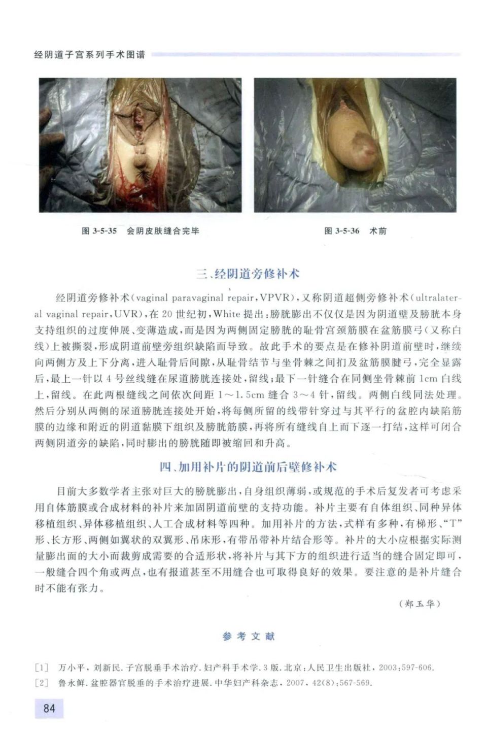 经阴子宫全切除及阴道前后壁修补(图谱)