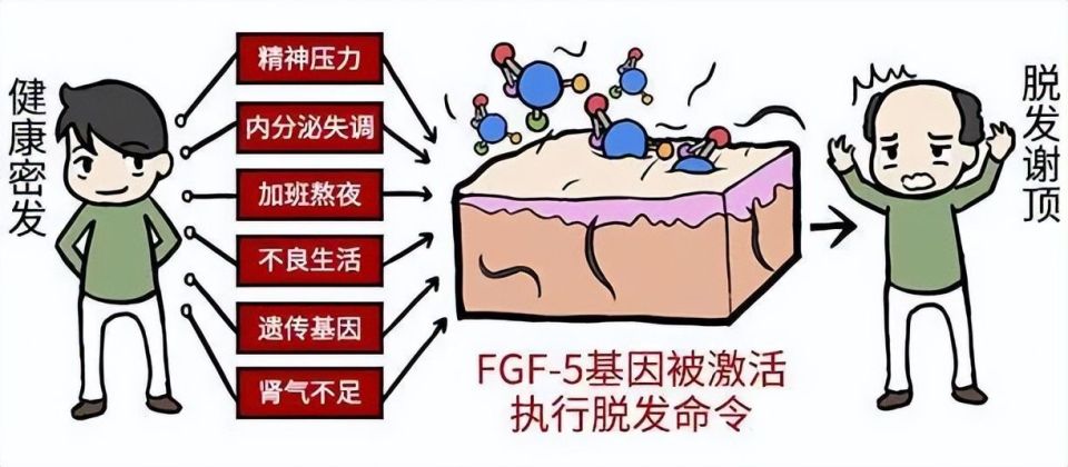 天道好轮回,脱发绕过谁?--脂溢性脱发早重视!-腾讯新闻