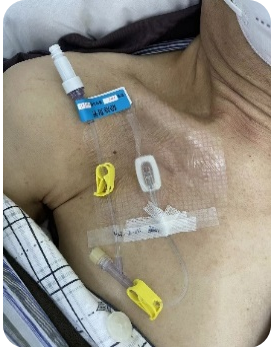制作囊袋,将注射座植入皮下,连接的导管插入中心静脉