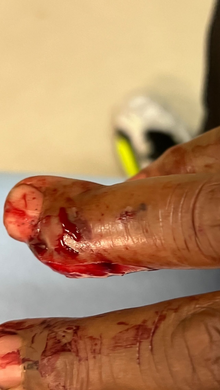 皮尔斯更新ig动态晒出自己手指严重受伤图片