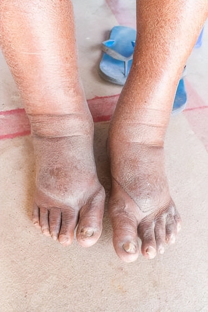 三,小腿经常抽筋糖尿病患者的下肢非常容易出现供血,供氧不足的情况