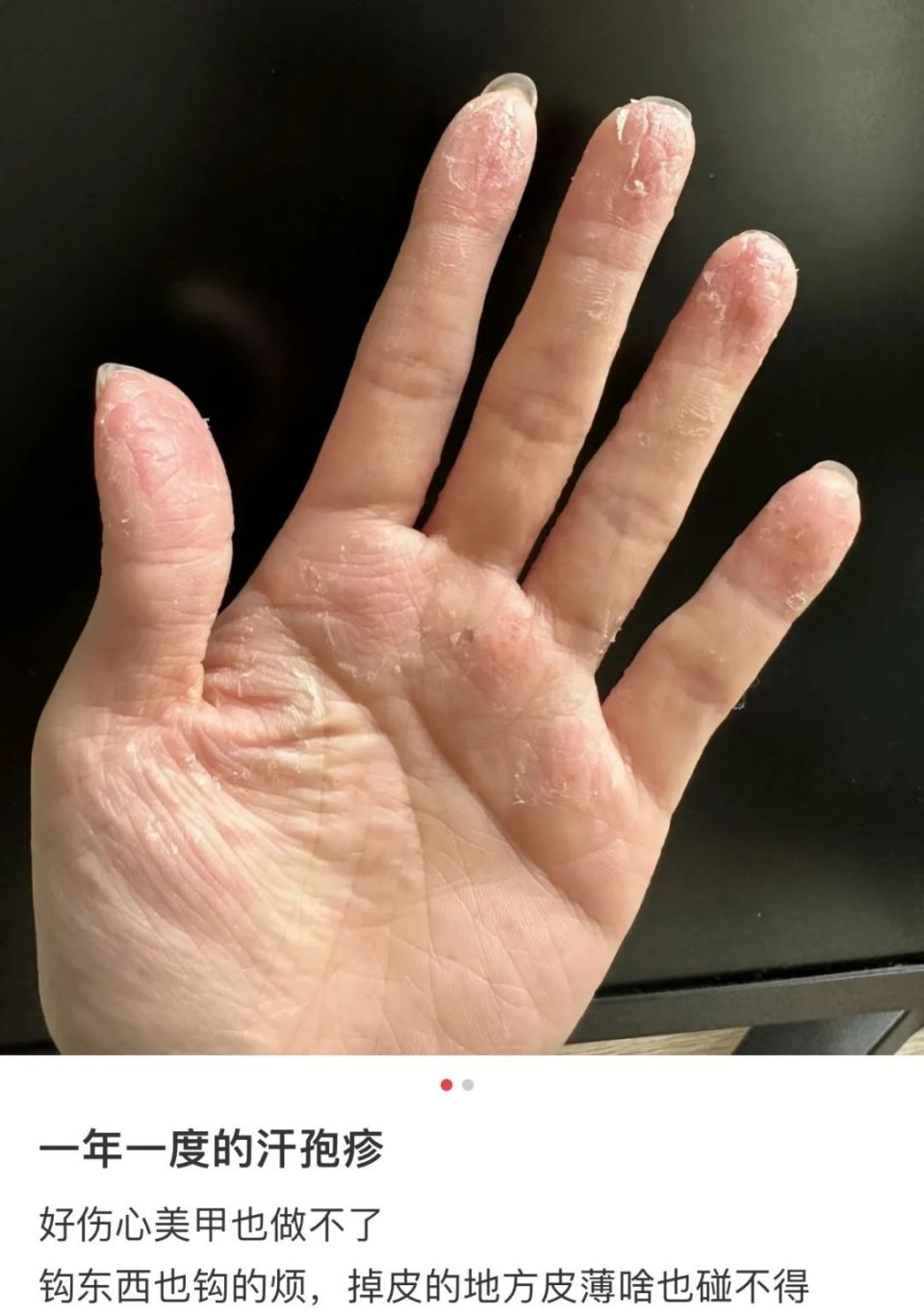 没有人可以在汗疱疹前面不改色.