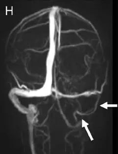 脑静脉窦血栓形成的诊断陷阱,这3个病例教你回避丨临床必备