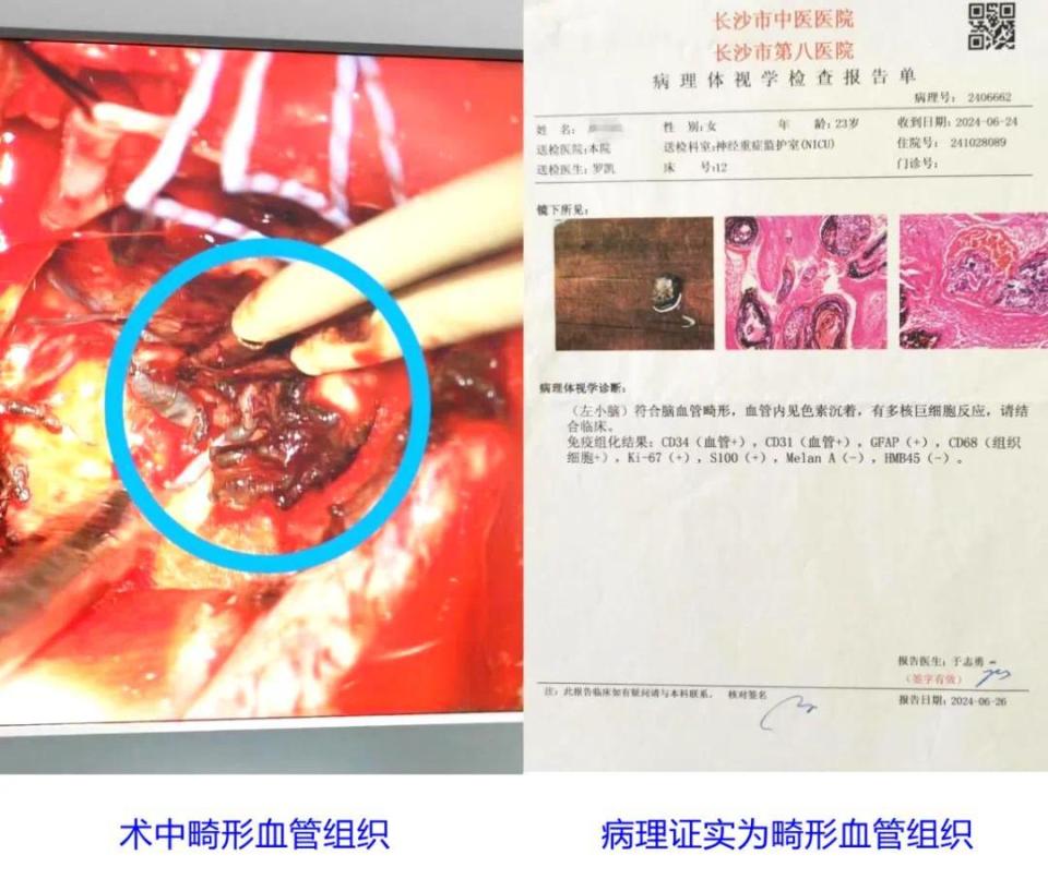 22岁小伙来长沙探亲突发脑出血,6小时手术,10天术后护理助他转危为安