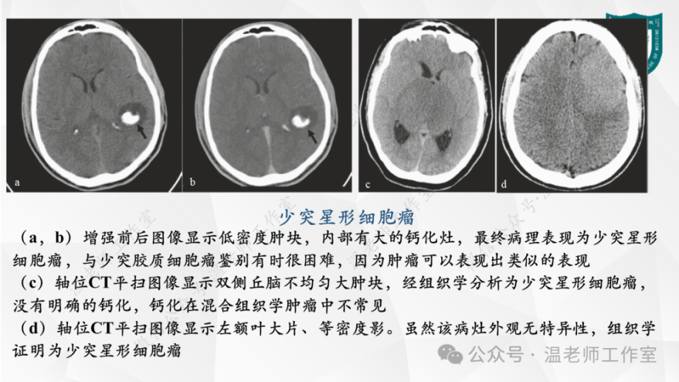 中枢神经系统的病例影像:脑肿瘤