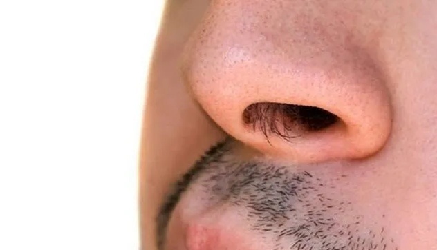 为了深入了解为何一位脱发患者一个鼻孔有鼻毛而另一个没有,美国加州