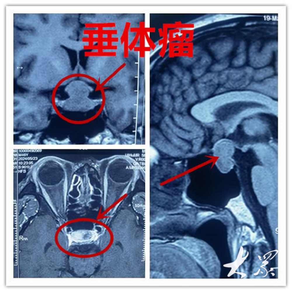 有可能是垂体瘤