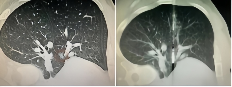 微波针是什么体检发现肺磨玻璃结节，只能随访手术二选一？“超微创”的微波消融，了解一下_https://www.jmylbn.com_新闻资讯_第2张