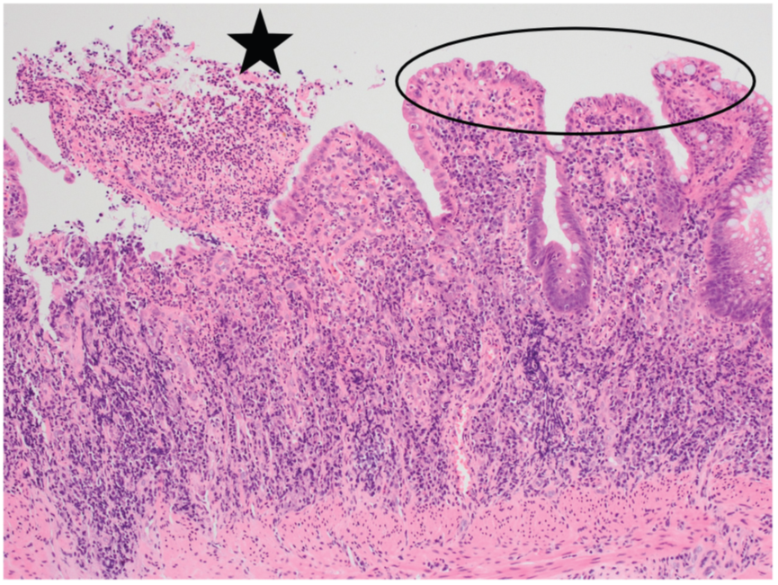 指南共识 | ecco官方立场: 如何定义炎症性肠病组织学异常