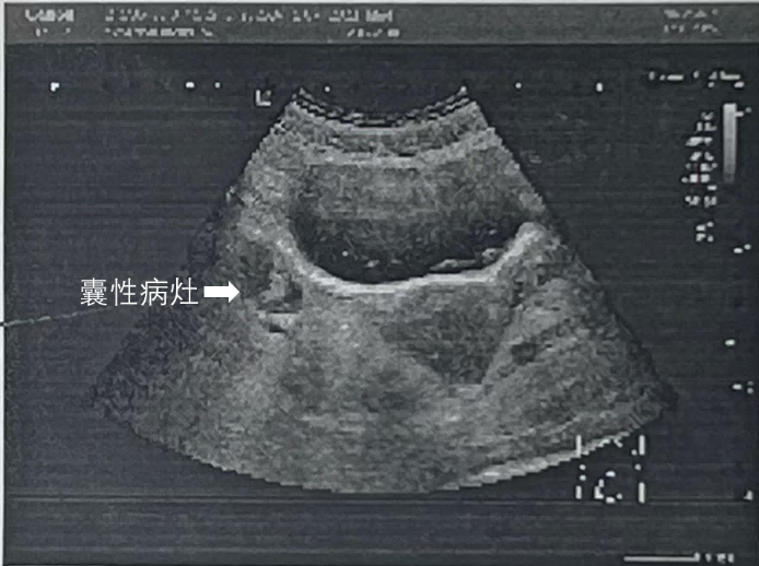 29岁李老师患罕见抗NMDAR抗体脑炎，