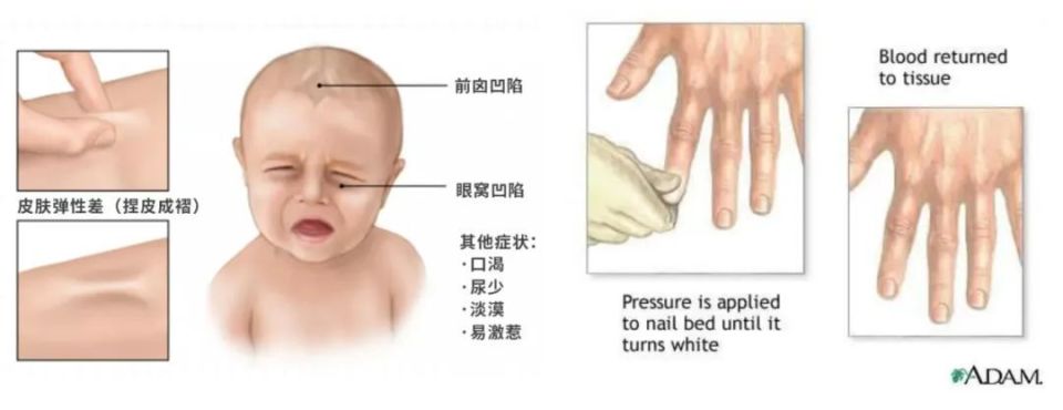 脱水眼睛凹陷图片图片