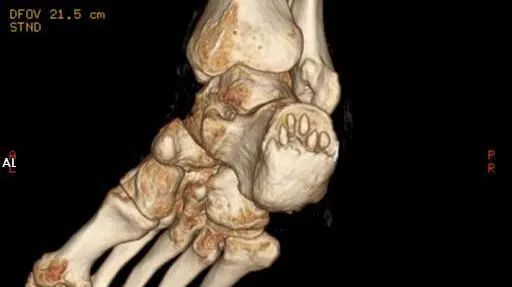 手术方案为右跟腱止点病损钙化骨块切除术,跟骨截骨术,跟腱止点锚钉