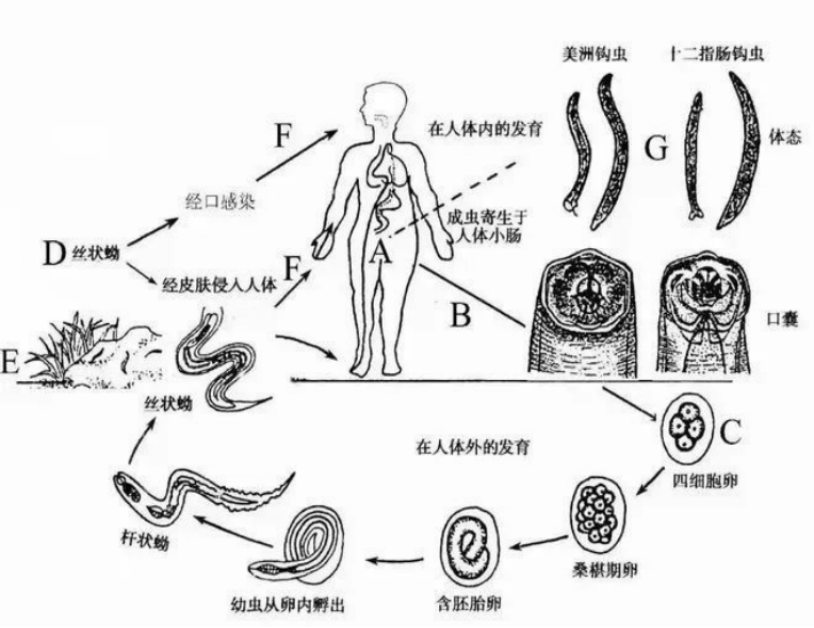 老人贫血20余年 元凶竟是"钩"在肠壁上的寄生虫