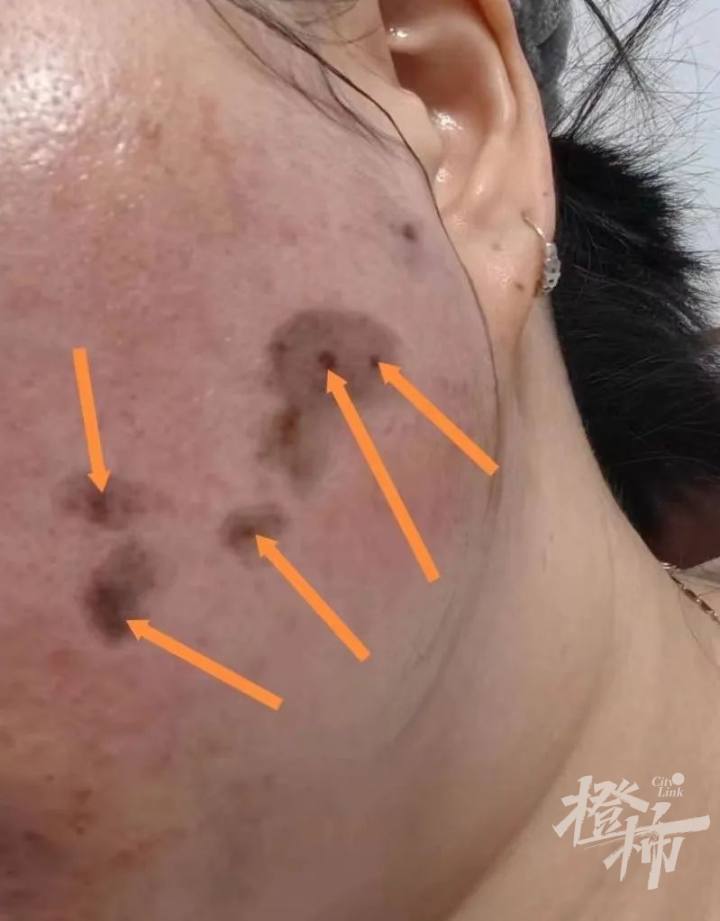 网购祛斑产品浙江女子脸上腐蚀出血洞