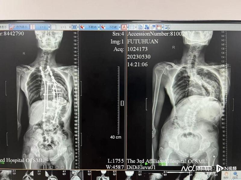 他8岁开始脊柱侧弯，38岁时脊柱弯成问号，医生：要早治！_腾讯新闻