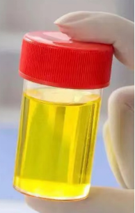 术后血尿真实图片正常成人的尿量:1000-2000ml/天;多尿:>2500ml/天;少