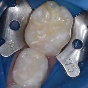 橡皮障隔湿2颗乳磨牙02 适应证的选择窝沟封闭只针