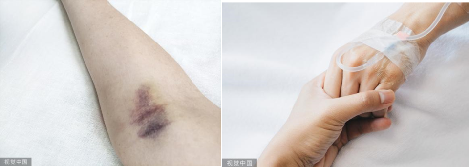 穿刺淤青不烦恼 轻松应对来消除