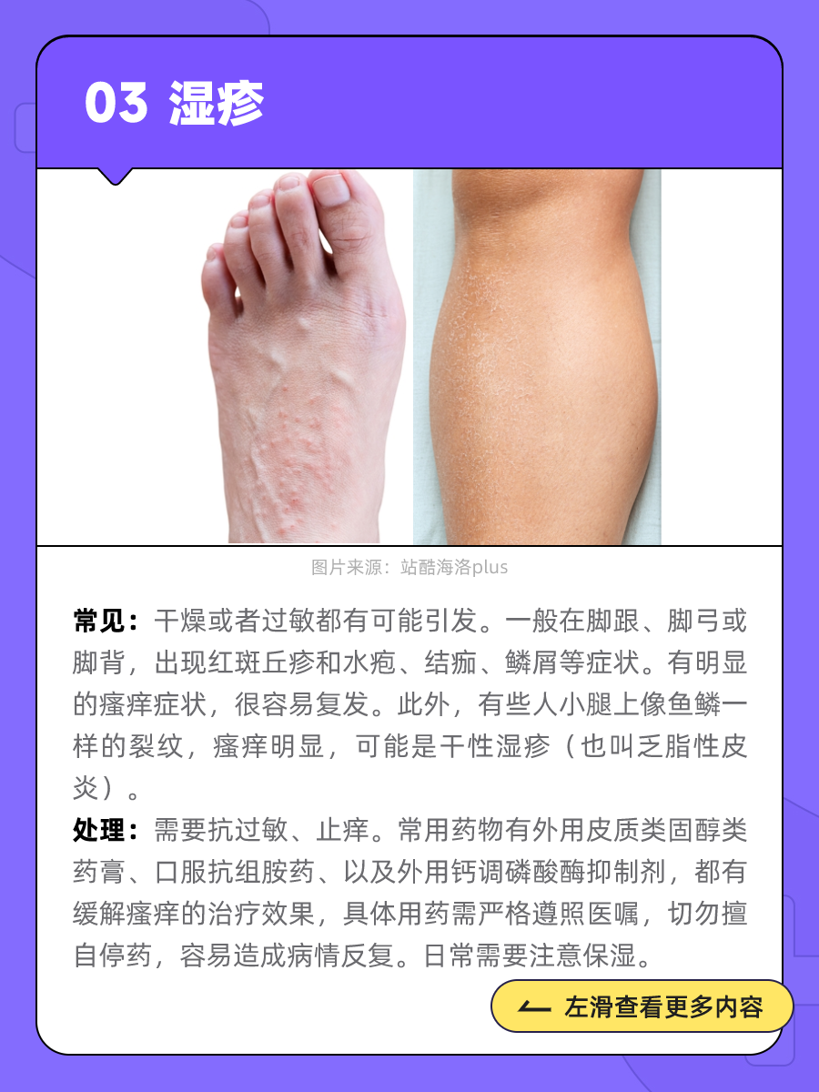冬天脚痒得厉害？有一种情况可能会传染_腾讯新闻