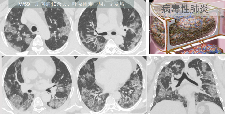 我们要想到两个病:在具有流行性和季节性的时候,想到病毒性肺炎的可能