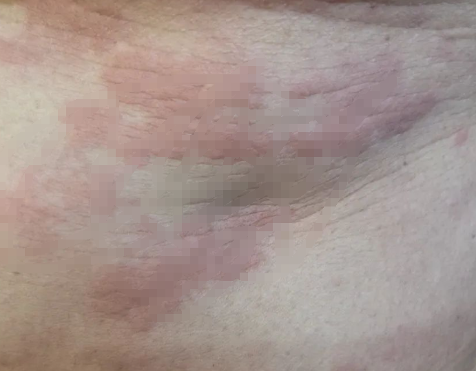 在抓挠也不止痒后,董阿姨这才发现,自己身上起了大片大片的红色斑块.