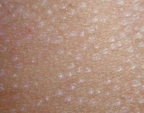 为什么健身后身体会出现汗斑