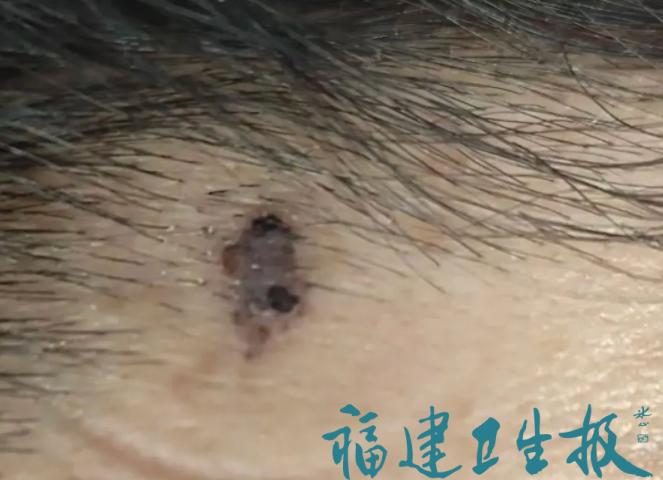 福州刘女士美容院万元祛黑斑竟致皮肤癌？激光治疗背后藏着啥风险