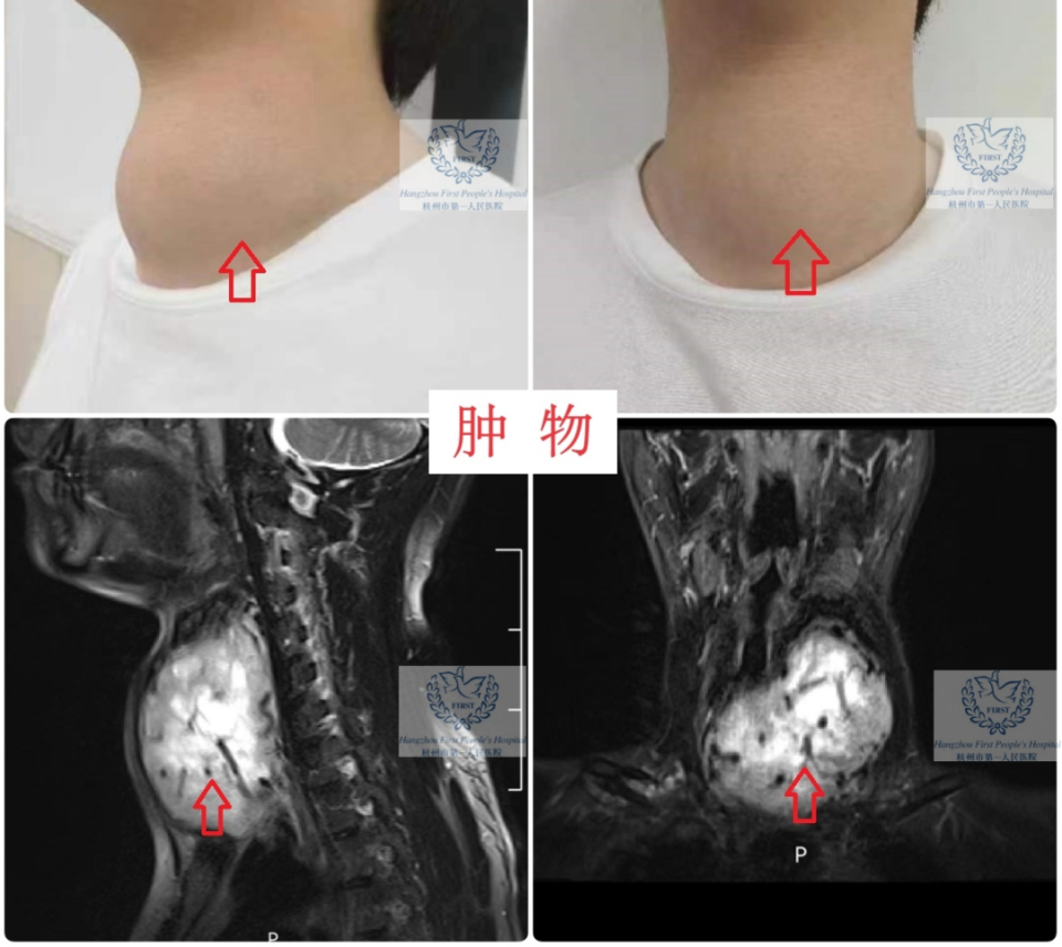 甲状腺结节真人图片