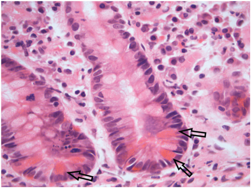 指南共识 | ecco官方立场: 如何定义炎症性肠病组织学异常