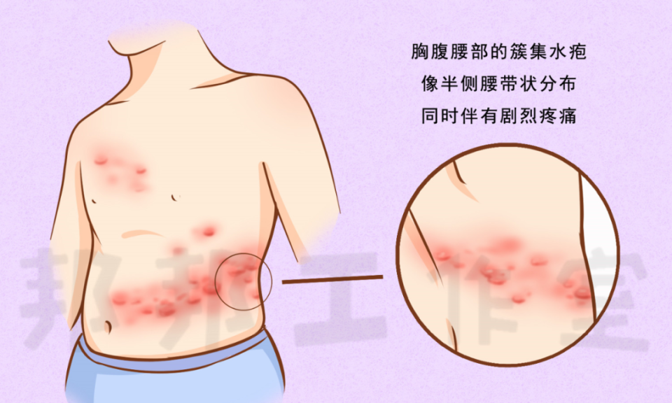 带状疱疹位置图片