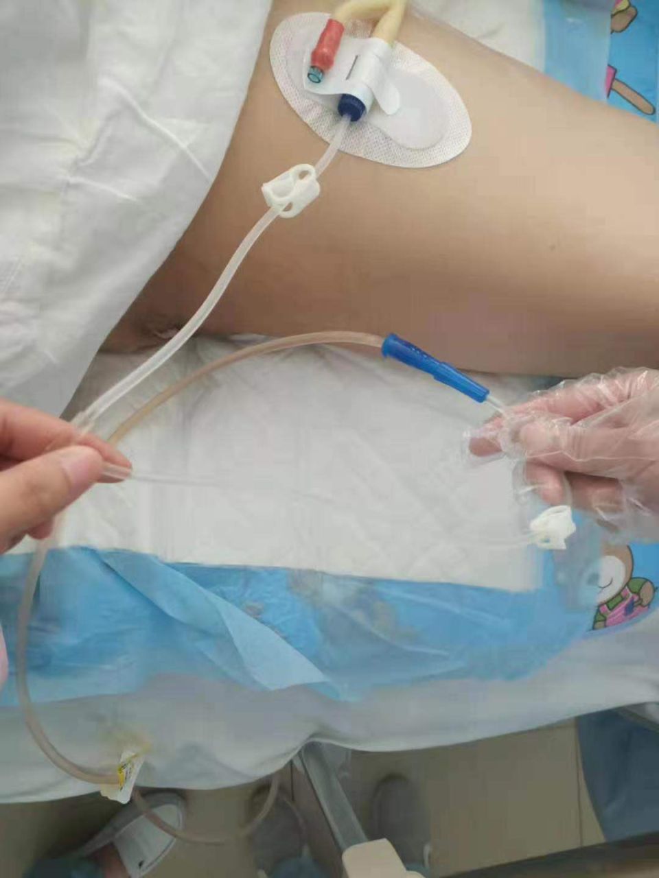 留置导尿时应用膀胱冲洗器的好处-腾讯新闻