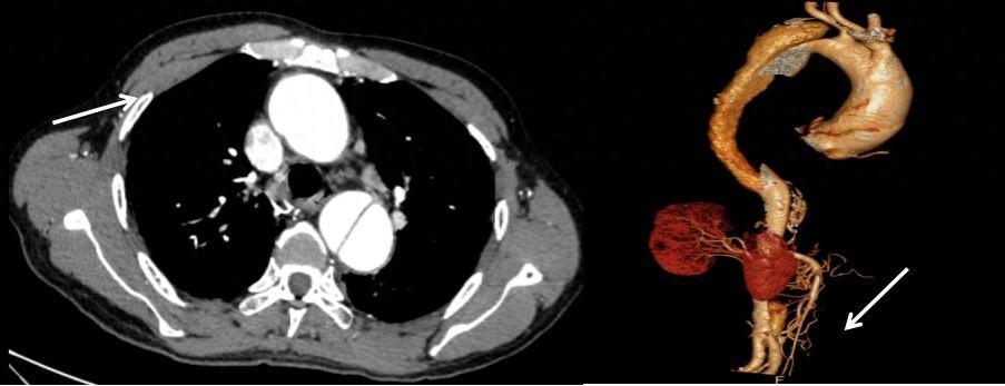 在当地医院行强化 ct 显示胸腹主动脉夹层(stanford b型),而当地医院