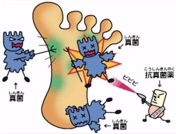 除灰指甲跟腳氣外,手癬,體癬,股癬等淺部真菌感染的病原體相似,存在