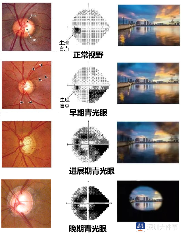 视野半径小于10度图片图片