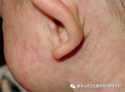 学校传染病高发季,这些症状别忽视!