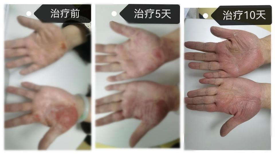 女子频繁清洁消毒手部，患上接触性皮炎_腾讯新闻