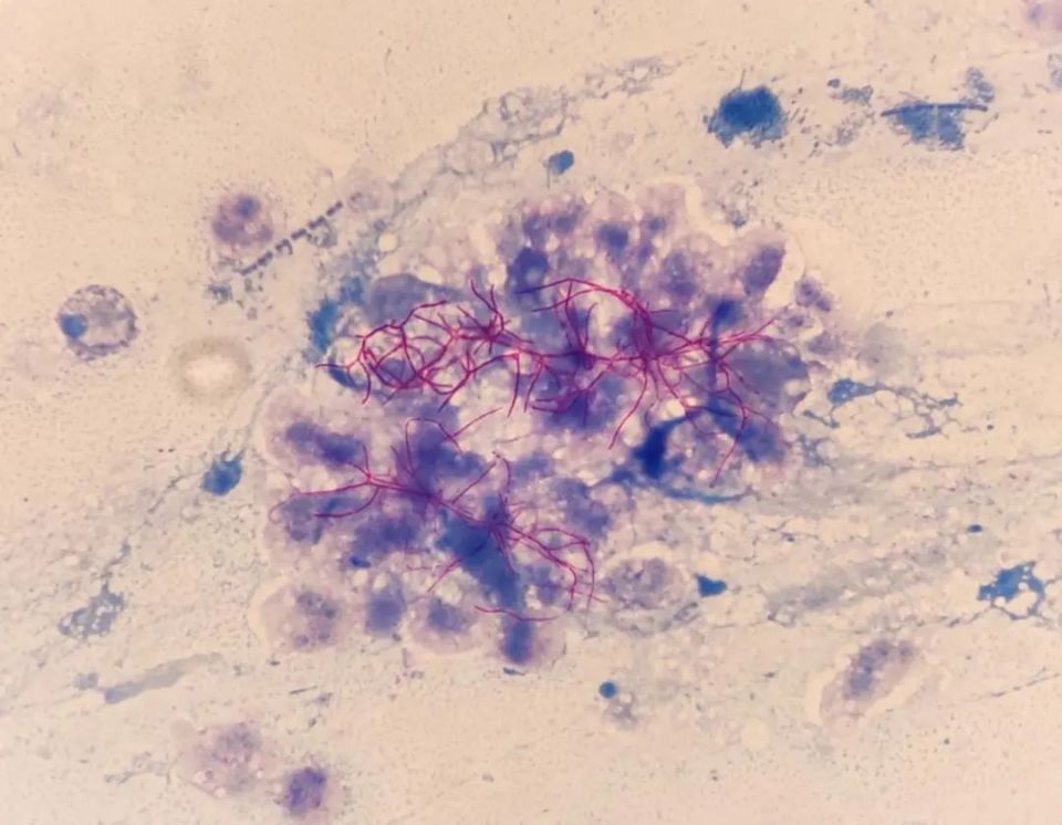 千丝万缕"诺卡君",咳咳痰痰"诺卡菌"