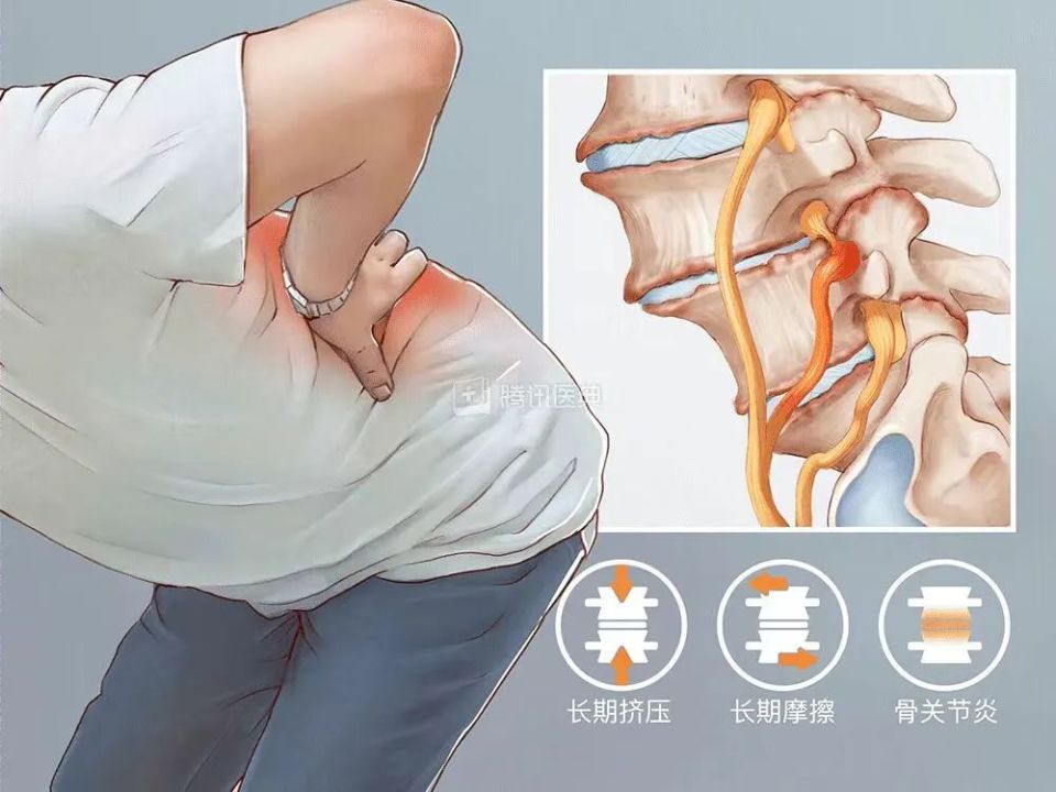 【朝医科普】大夫，长骨刺了怎么办_腾讯新闻