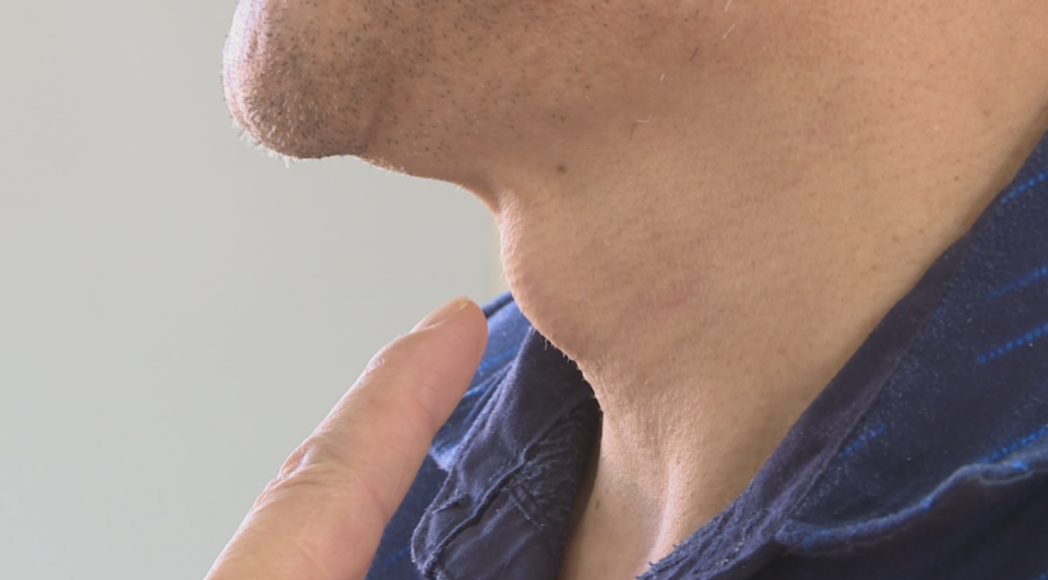 喉咙痛以为"热气" ?一查竟是囊肿