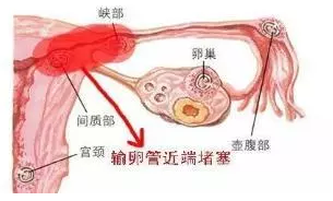 女性輸卵管近端堵塞和遠端堵塞有什麼區別