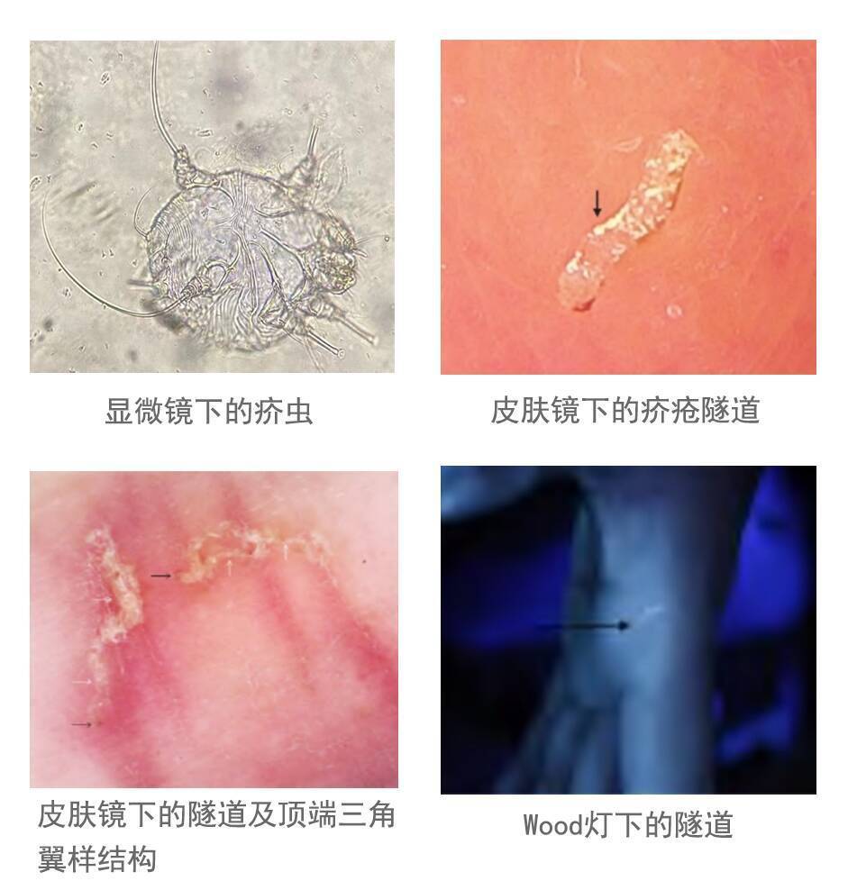 在皮肤里"挖地道"的小虫子——疥虫