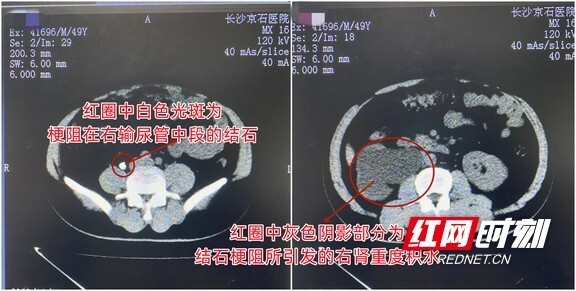 男子腰部偶有脹痛卻漠然置之近期檢查發現右腎被結石損壞