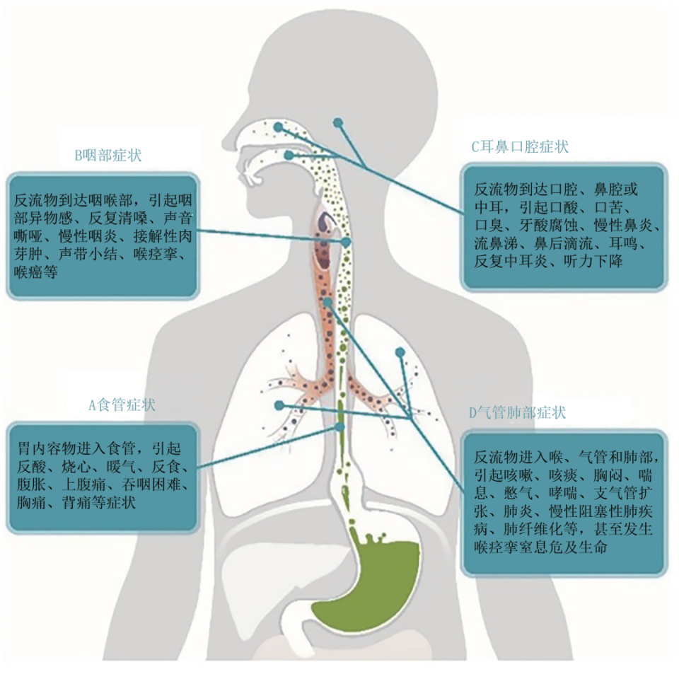 十二指肠内容物反流至食管,口咽或呼吸道引起的不适症状和/或并发症